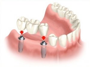 Puente fijo sobre implantes