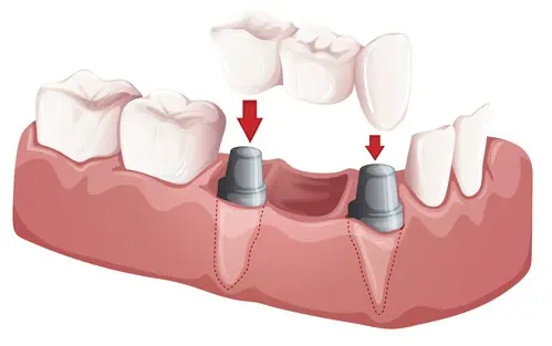 imagen de un puente dental fijo