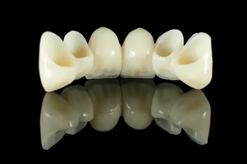 Puente fijo en cerámica para reeemplazar dientes faltantes