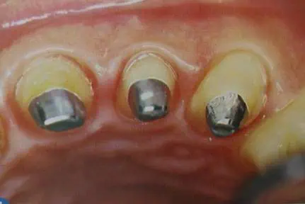 Muñones dentales reconstruidos con pernos de metal