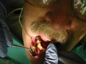 Escalamiento dental