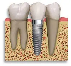 implante dental