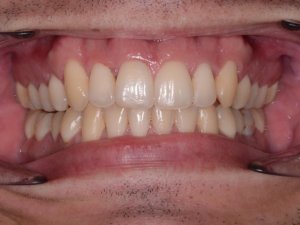 gingivectomía precio