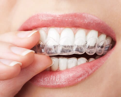 Alineadores dentales invisalign precio
