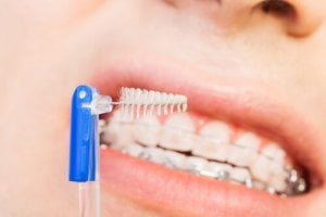 Cepillo interdental al usarse en una persona con ortodoncia