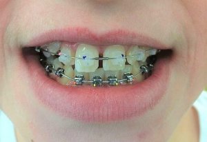 mix of clear and metal braces