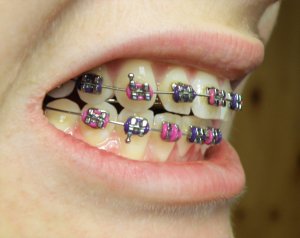 smile with colour braces