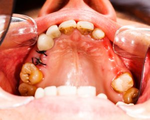 Fotografía de una extraccion dental