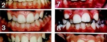 Maloclusion, cuando tus dientes están ubicados de forma incorrecta en tus maxilares