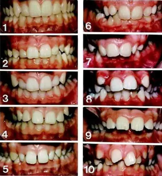 Maloclusion, cuando tus dientes están ubicados de forma incorrecta en tus maxilares