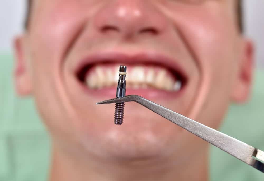 implantes dentales en turquía precios