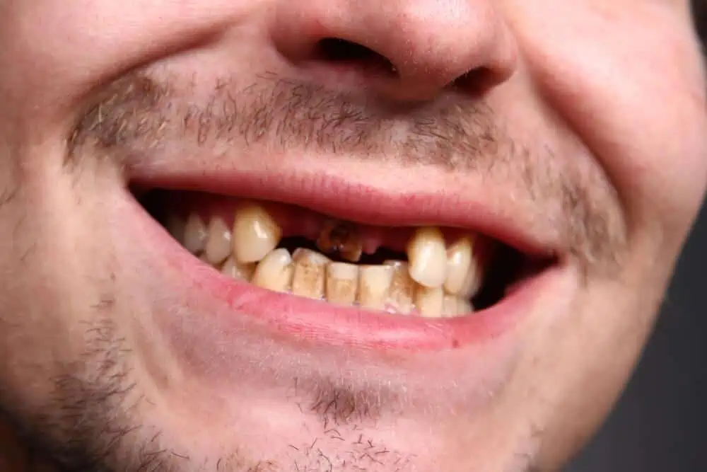 Imagen de paciente con ausencia de dientes anteriores