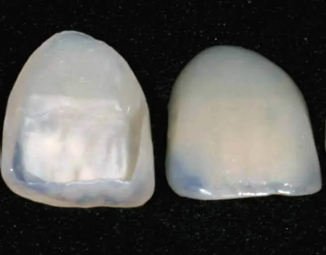 tipos de carilla dental