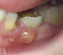 Absceso dental puede producir halitosis