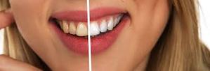 cambiar color en los dientes luego de un blanqueamiento