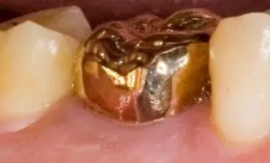 corona dental en oro