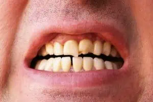 Hombre con dentadura diente astillado