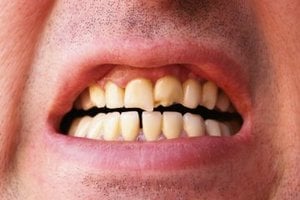 causas y reparación de un diente roto