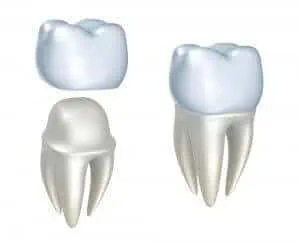 fundas dentales diente tallado