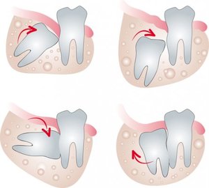 Causas de la pericoronaritis