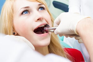 Extraccion de diente en paciente joven