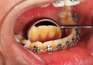 sarro en lingual de los dientes antero-inferiores y alrededor de brackets