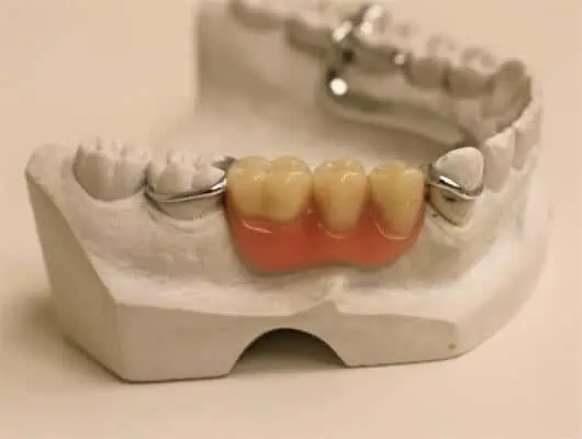 Prótesis parcial dentomucosoportada