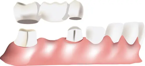 características de un puente dental fijo tradicional