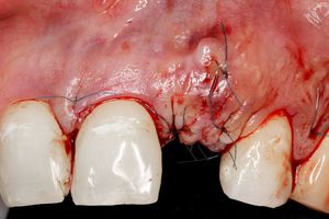 cirugía periodontal y ácido hialurónico