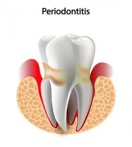 Enfermedad periodontitis