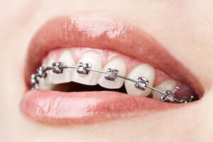 ortodoncia para corregir los dientes apiñados