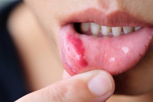 mucocele y lesiones del labio inferior