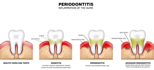 progreso de la periodontitis