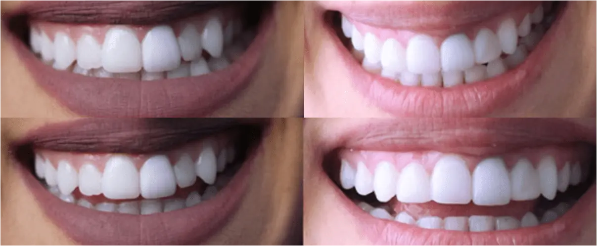 Antes y después de una sonrisa usando carillas dentales 