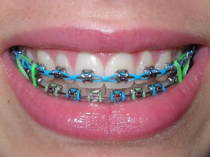 gomas de brackets