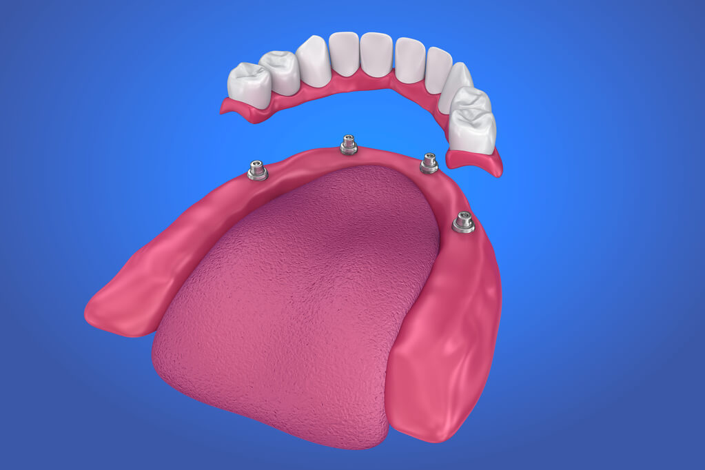 prótesis fija sobre implantes