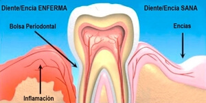 proceso de la inflamación de encías
