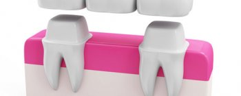 Estructura puente dental