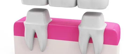 Estructura puente dental