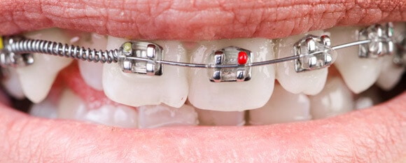 Ortodoncia Tipos De Aparatos Dentales Y Precios En Espa a