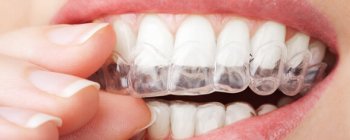 invisalign aparatos