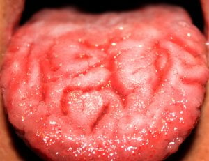 imagen de lengua con candidiasis oral