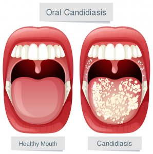 imagen de candidiasis oral vs boca sana