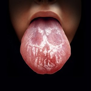 imagen de paciente con leucoplasia bucal en la lengua