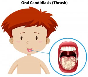 candidiasis oral niños