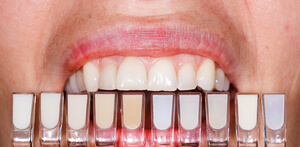 faccette dentali recensioni