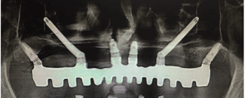 Implantes cigomáticos