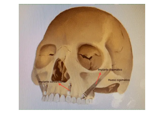 implante cigomatico precio