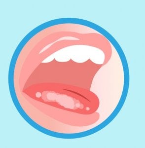leucoplasia, manchas en la lengua