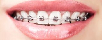 Braces for adults and teens